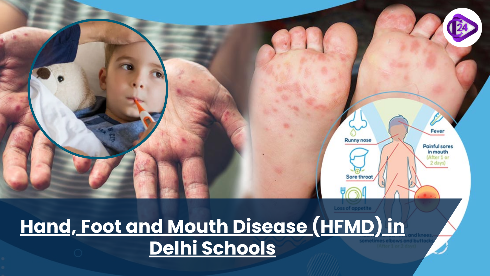 Hand, Foot and Mouth Disease (HFMD) in Delhi Schools