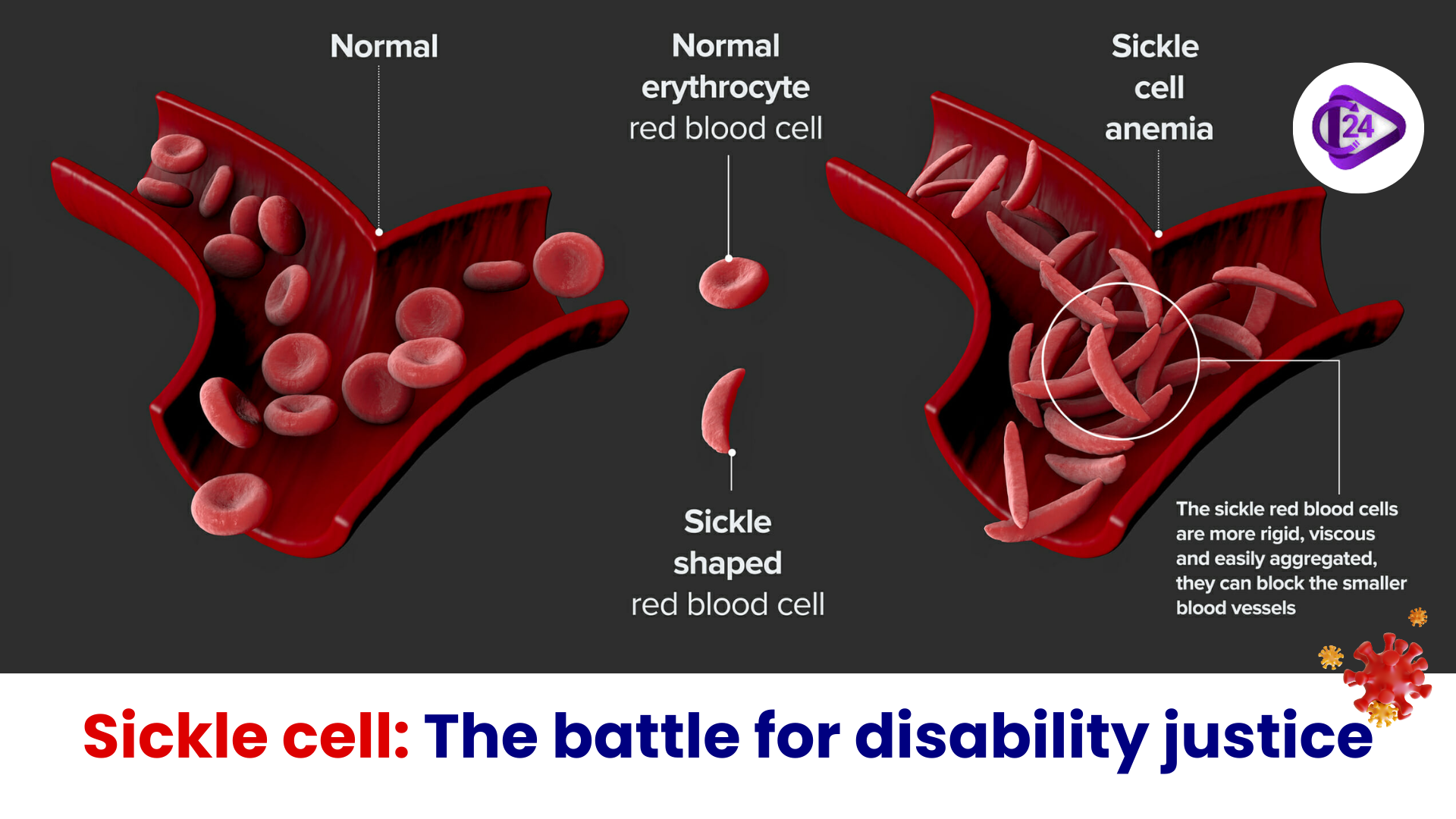 Sickle cell: The battle for disability justice