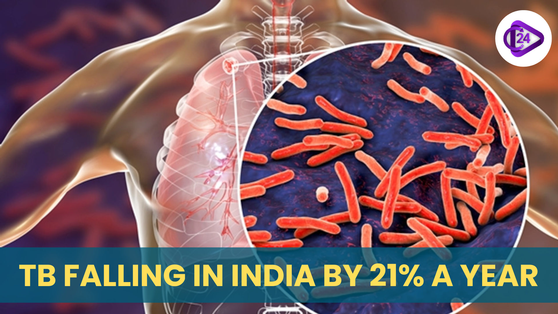 India’s TB Fight Gains Momentum with Sharp Decline and Ongoing Challenges