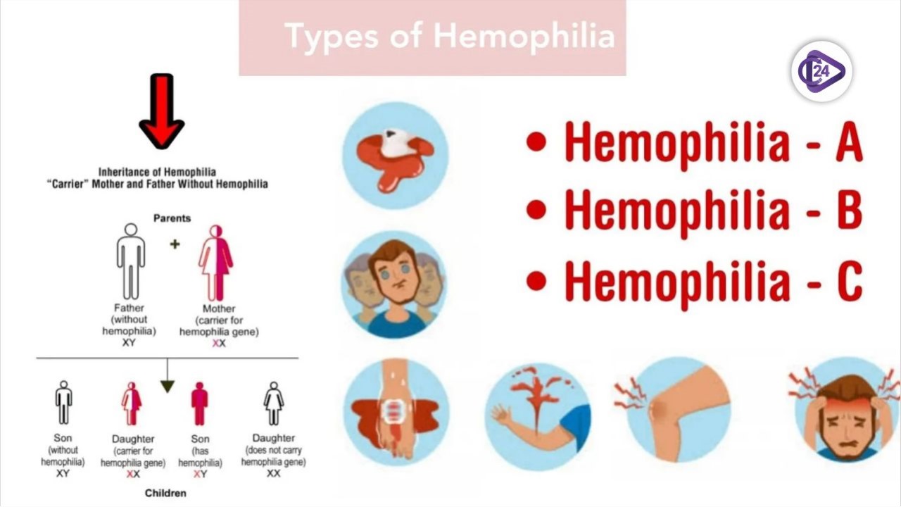 Gene Therapy for Hemophilia A